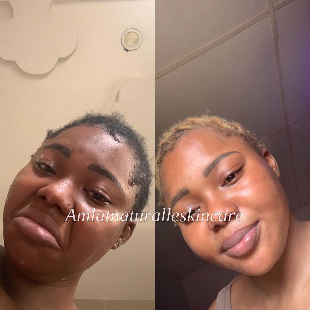 Amaka O. Amlat Ultra Glow Kit result