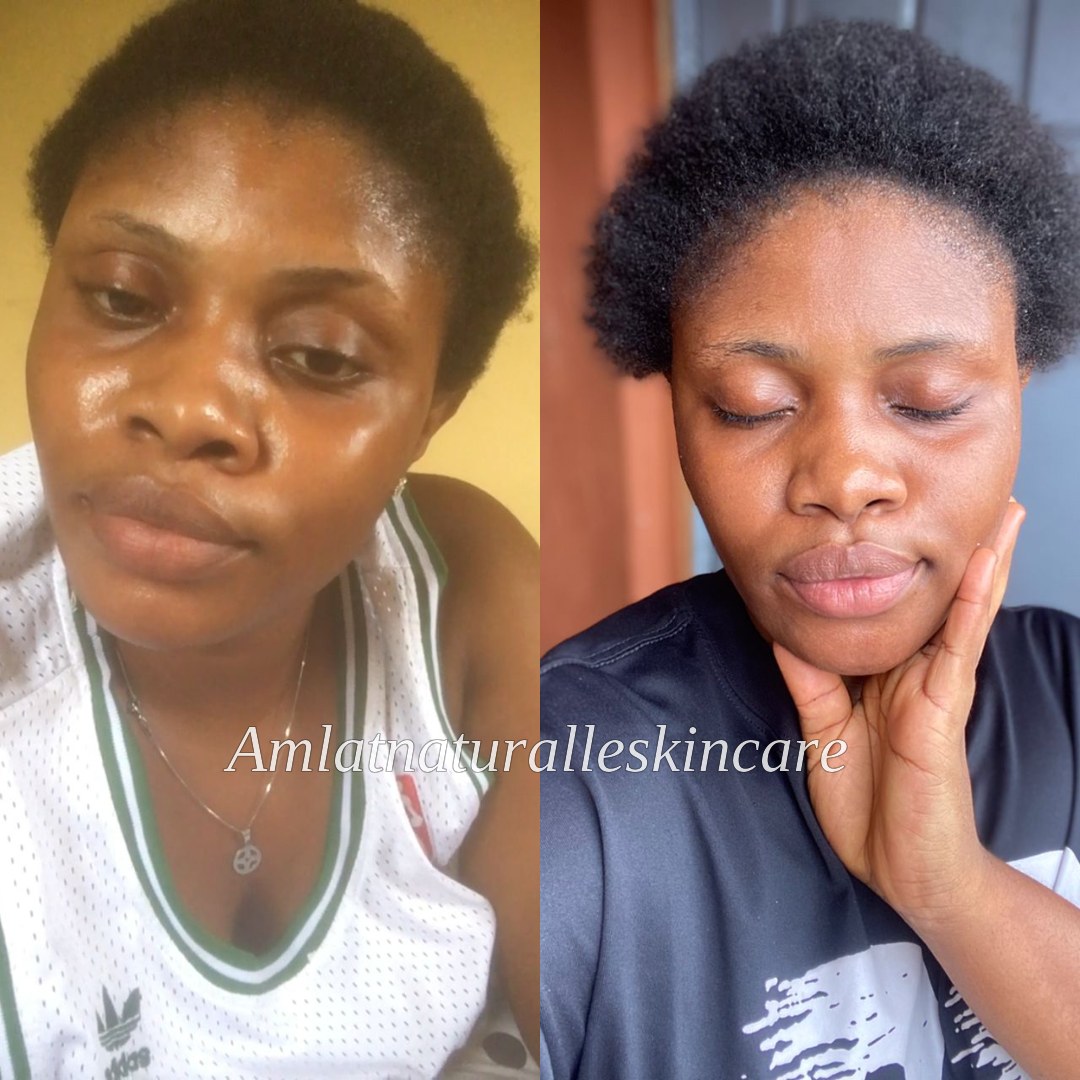 Ifeoma C. Amlat Ultra Glow Kit result