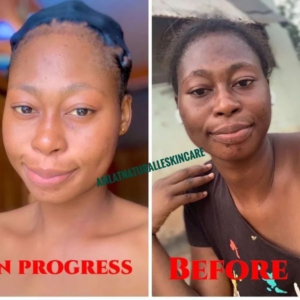 Blessing I. before and after using the Amlat Ultra Glow Kit