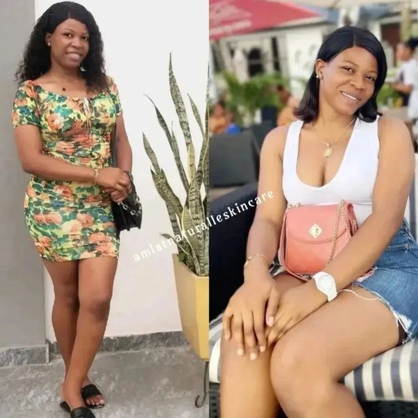 Tolulope A. before and after using the Amlat Ultra Glow Kit