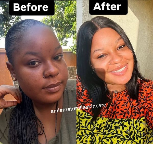 Chiamaka N. before and after using the Amlat Ultra Glow Kit